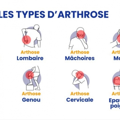 L'arthrose touche 10 millions de personnes en France, et c'est le sujet de la chronique sant du jour sur RMB